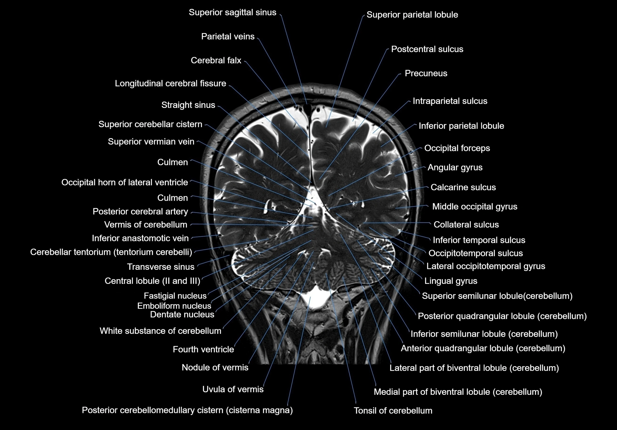MRI Brain coronal cross sectional labelled anatomy 3T image  -img-00001-00054.webp